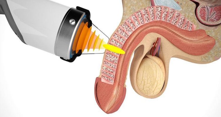 Erectile dysfunction impotence