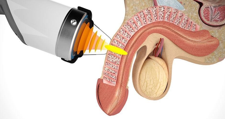 Erectile dysfunction impotence